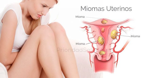 MIOMAS UTERINOS