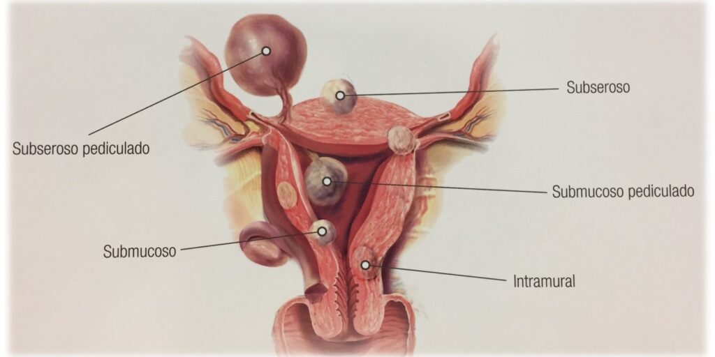  TIPOS DE MIOMAS