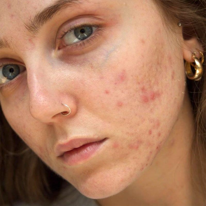 Oleosidade e acne