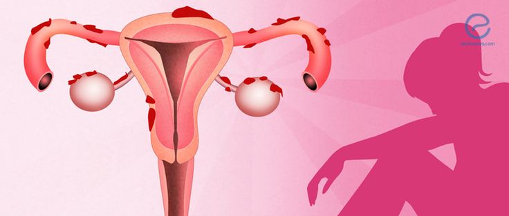 ENDOMETRIOSE
