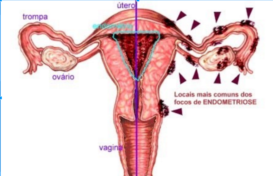 FOCOS DE ENDOMETRIOSE