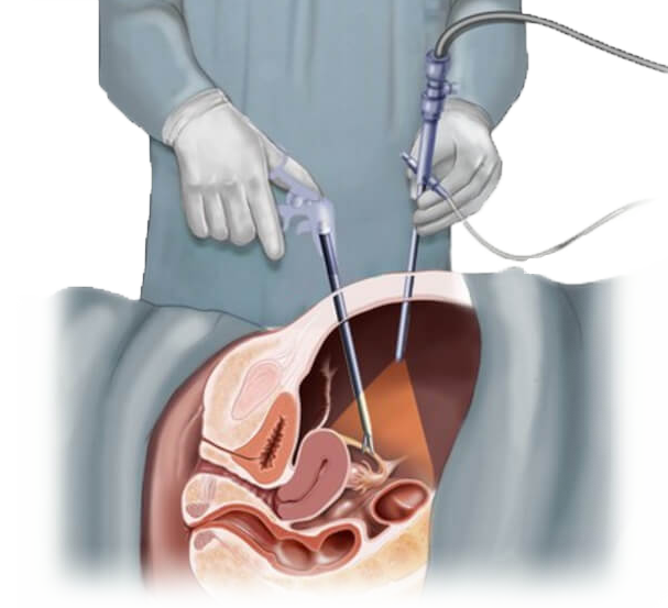 LAPAROSCOPIA