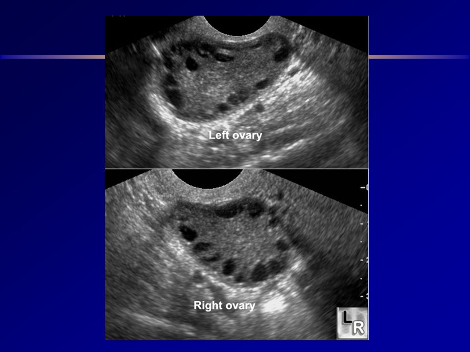 Síndrome dos Ovários Policísticos (SOP)