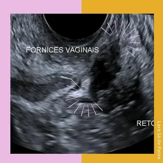 USOM MAPEAMENTO ENDOMETRIOSE