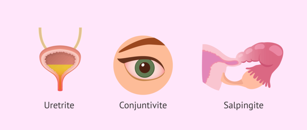 Complicações da Clamídia