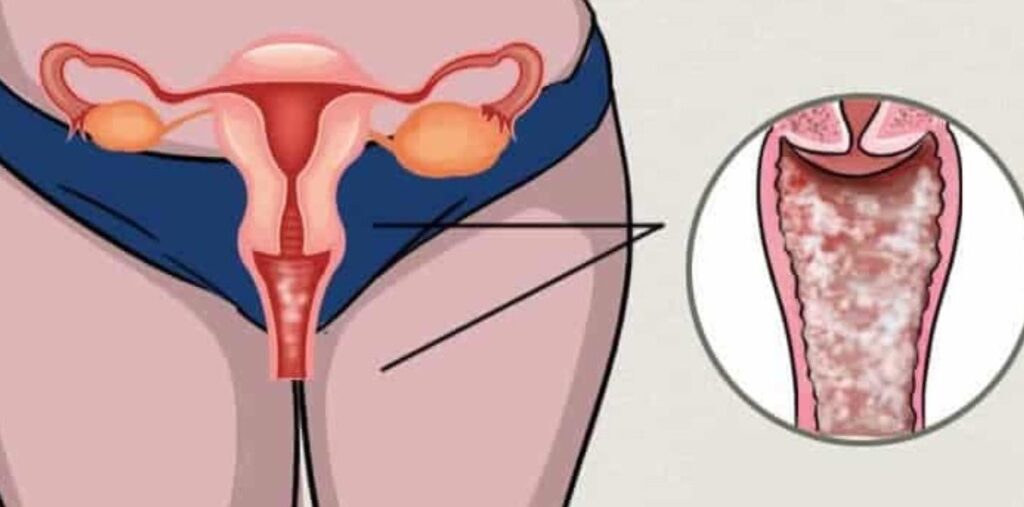 vaginose bacteriana (VB) 