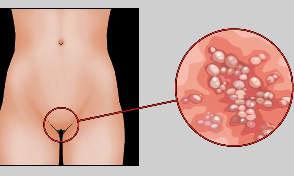 Sintomas da Herpes Genital